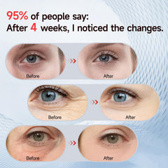 Azilaser 3D wrap design demonstrates even under-eye light coverage and comfort