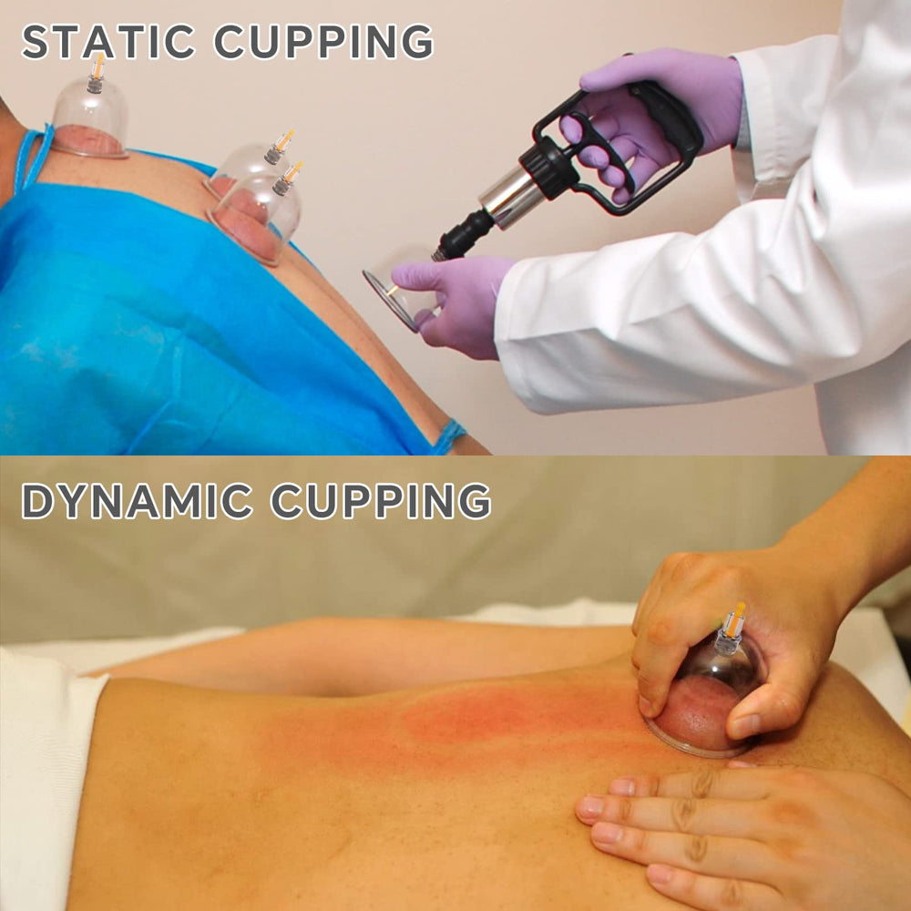 AIKOTOO cupping set designed for safe, reusable home use