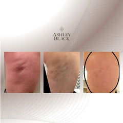 FasciaBlaster Nugget reachs tricky zones like inner thigh and neck with ease.