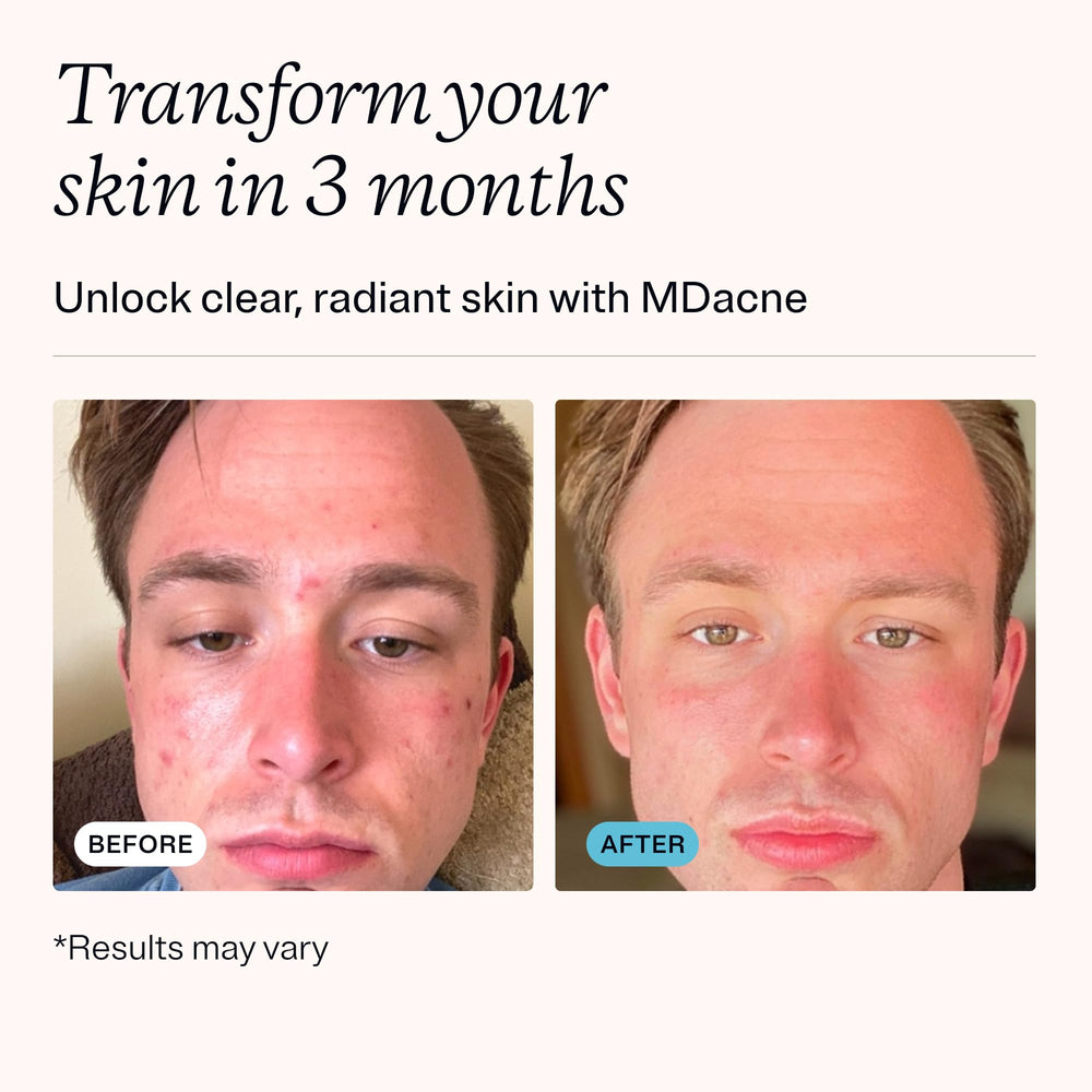 MDacne packaging box flatlay emphasizing dermatologist-backed approach