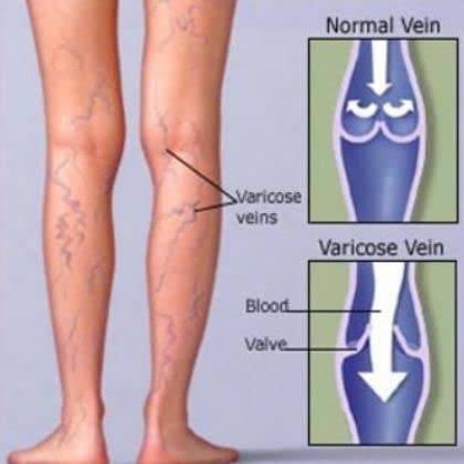Mivolis Vein Gel 100 ml tube ready for daily leg care.