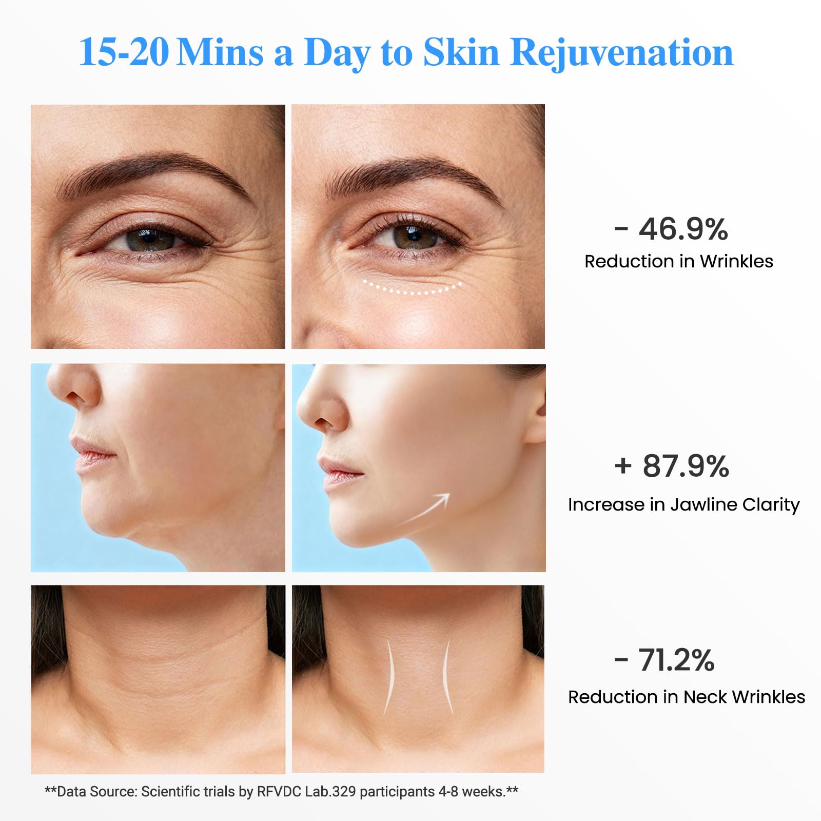 RFVDC V-line sculpting with precise massage for defined jawline.