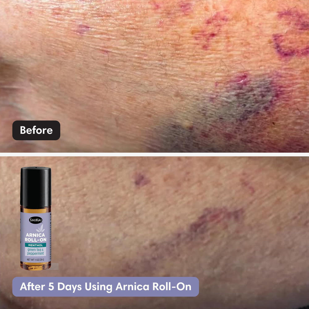 ShiKai Arnica Roll On skin-application demonstrates easy roll-on for targeted areas like knees